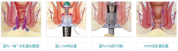 图示“PPH无刀除痔”治疗过程